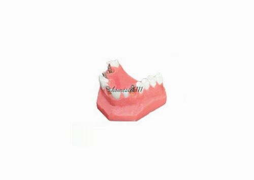 XINGXING Dental Teeth Model Upper Jaw Implant model 2012-1  HO