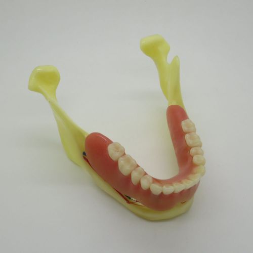 New Dental Model #2014 02 - Mandible Implant and Overdenture Demo Model (Yellow)