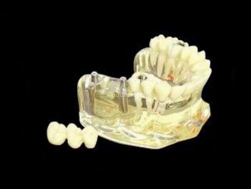 1*XINGXING Teeth Model Uper Jaw Implant Model With Bridge and Caries 2006 CE