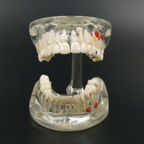 New Dental Study Teaching Model Disease Model Removable Teeth